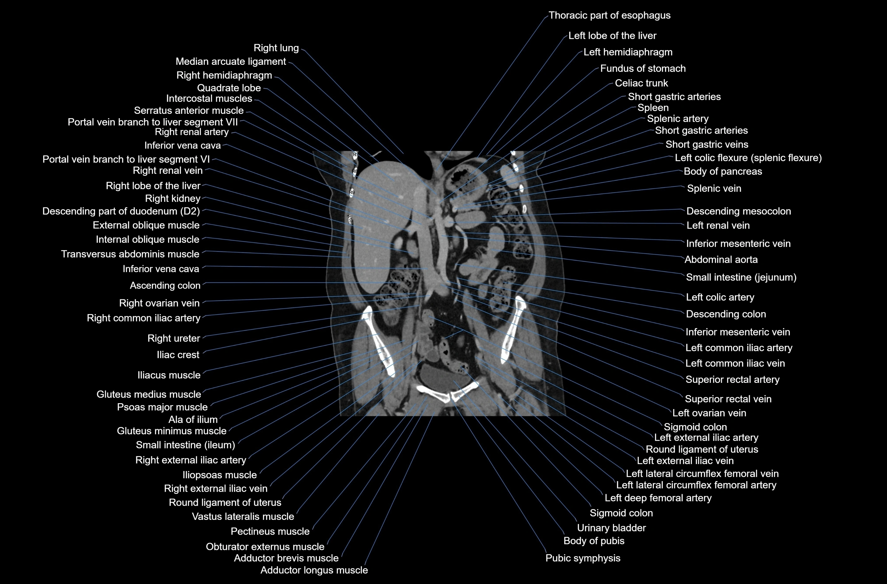 CT abdomen coronal cross sectional anatomy labelled radiology image-00045.webp